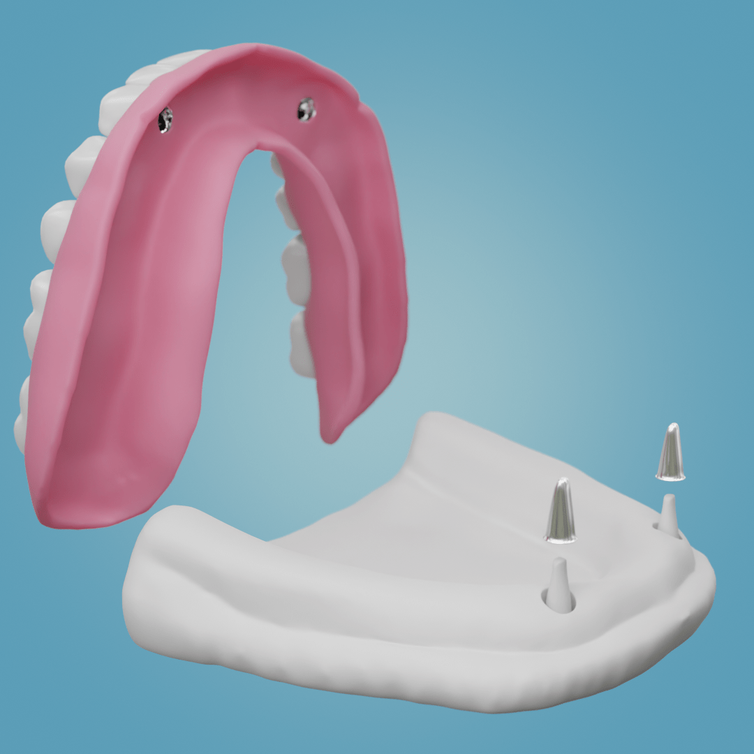 Mehr über den Artikel erfahren Coverdenture
