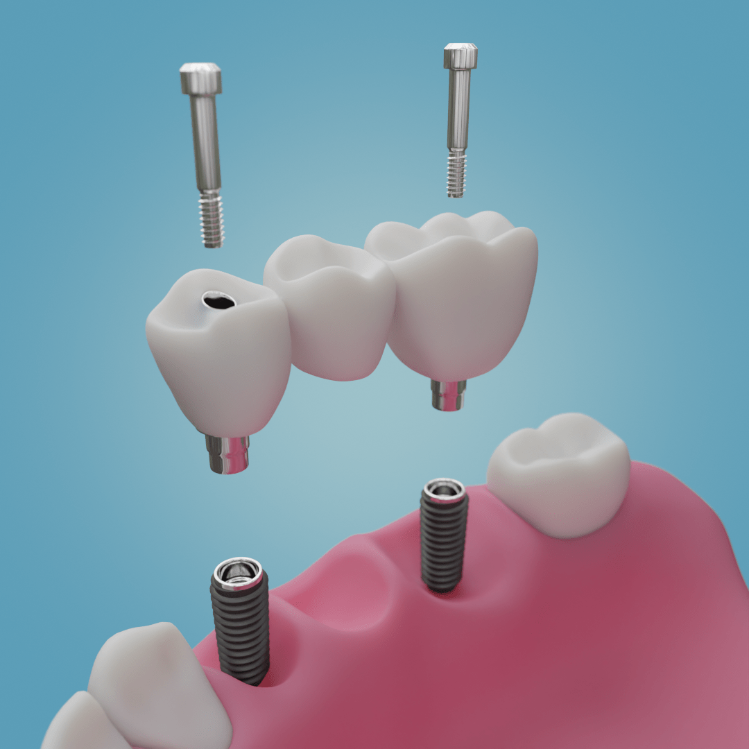 Mehr über den Artikel erfahren Verschraubte Brücke auf Implantat